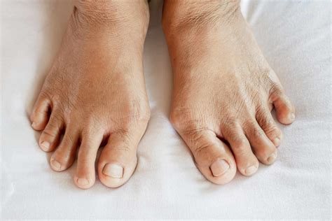 Psoriatic Arthritis Feet Online Discounts Save 52 Jlcatjgobmx