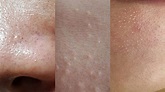 【醫師專欄】臉上的粉刺要不要清？清粉刺會不會把毛孔越清越大？ | userISM分效美療
