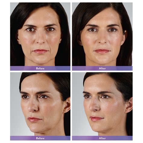 Facial Filler Before And After Feel Ideal 360 Med Spa Southlake Tx