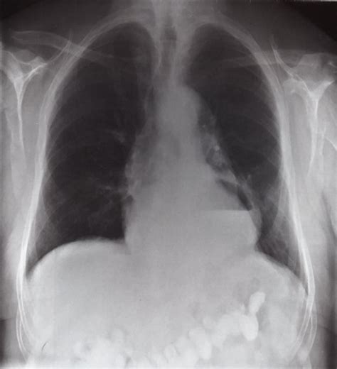 Paraesophageal Hernia X Ray