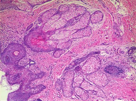 Histopathology Of Nevus Sebaceous Reveals Acanthosis And A Large Number