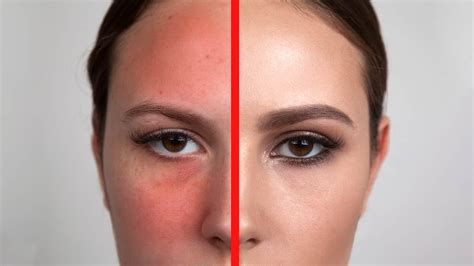 Rosacea Treatment Bristol Ciao Bella Aesthetics