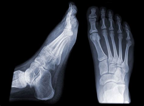 X Ray Of Foot