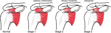 Treatment Of Rotator Cuff Injuries West Suburban Pain Relief