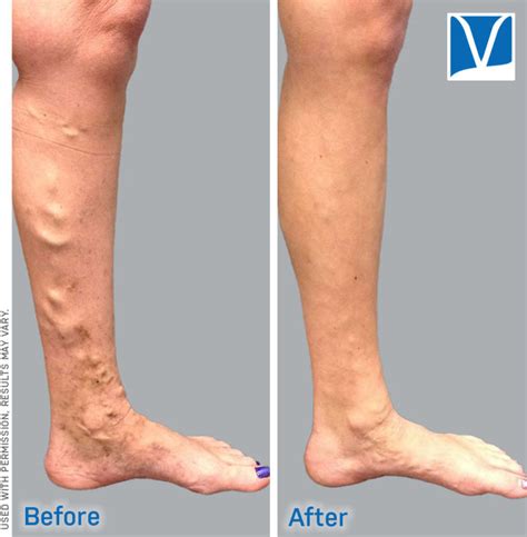 Know The Signs Symptoms And Treatments For Varicose Veins Portland