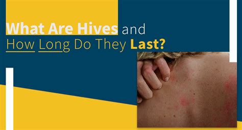 What Are Hives And How Long Do They Last Valley Skin Institute