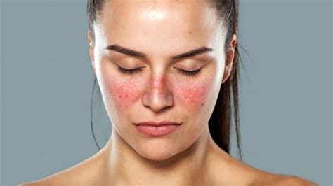8 Early Warning Signs Of Lupus You Need To Know Women Daily Magazine
