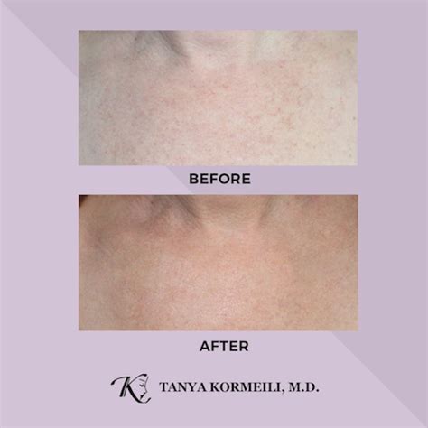 Best Skin Tone And Texture Treatment Los Angeles And Santa Monica Dr Tanya Kormeili Dermatology