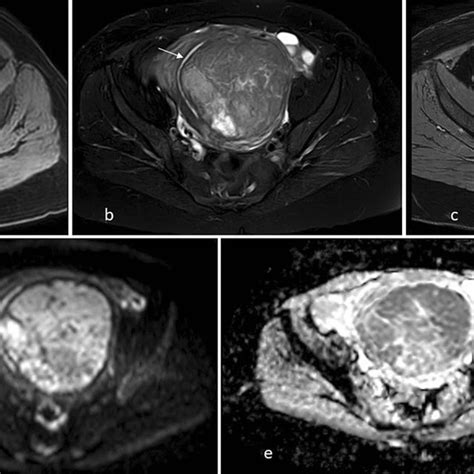 Mri Images Of A Typical Submucosal Leiomyoma Appearing Hypointense On
