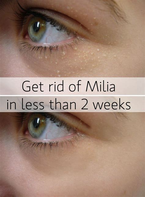 Milia Is A Quite Common Problem With A Not So Easy To Find Solution Or