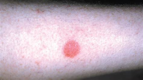 Red Spots On Forearm