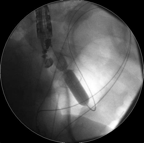 References In Eus Directed Transgastric Ercp For Roux En Y Gastric