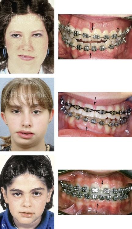 22 Asymmetric Mandibular Excess Growth Patterns Pocket Dentistry
