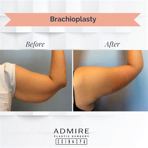 Incredible Results From This Arm Lift Surgery Brachioplasty