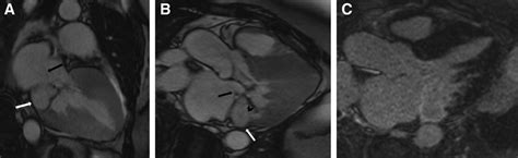 Caseous Calcification Of The Mitral Annulus With Atrial And Ventricular