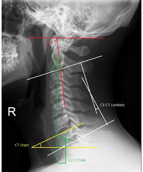 Correlation And Differences In Cervical Sagittal Alig