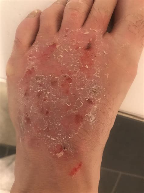 Rash On Feet Very Itchy Diagnoseme