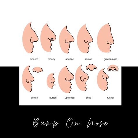 Bump On Your Nose Is A Non Surgical Nose Job The Answer