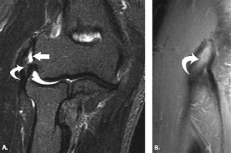 Elbow Tendons And Epicondylitis Radiology Key