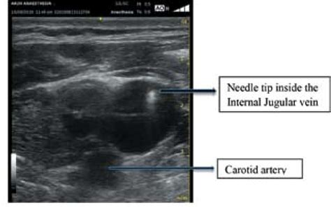 Figure 1 From Ultrasound Guided Central Venous Access A Review Of