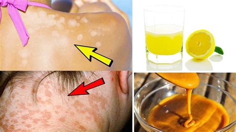 Pin By Tyler Bremer On Health Home Treatment Natural Home Remedies