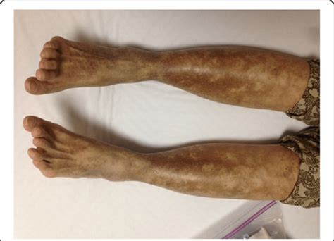 Livedo Reticularis On The Bilateral Lower Extremities Download