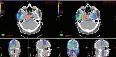 Proton Beam Radiotherapy For Acoustic Neuroma The Best Picture Of Beam
