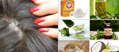 Home Remedies For Dandruff Itchy Scalp And Hairfall Herbs And Spices To