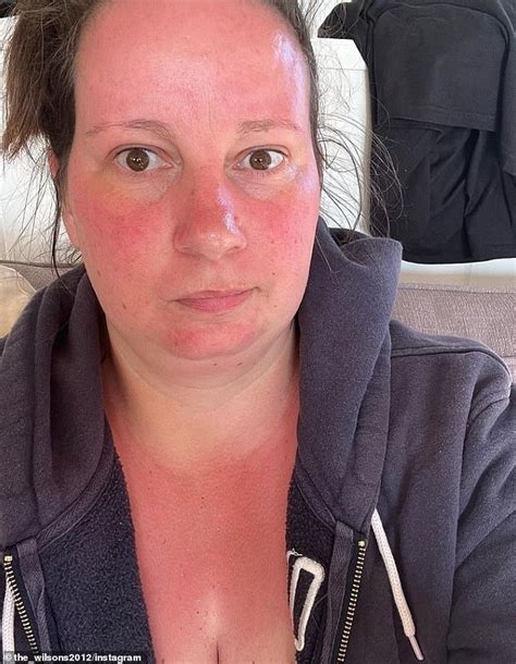 Baked Brits Share Snaps Of Red Skin After Getting Sunburnt During The