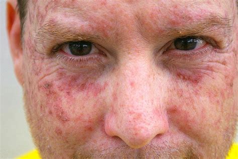 Sun Damage Treatments At Dr Al Rustom Skin And Laser Centre