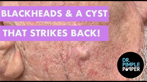 Blackheads And The Cyst That Strikes Back Youtube