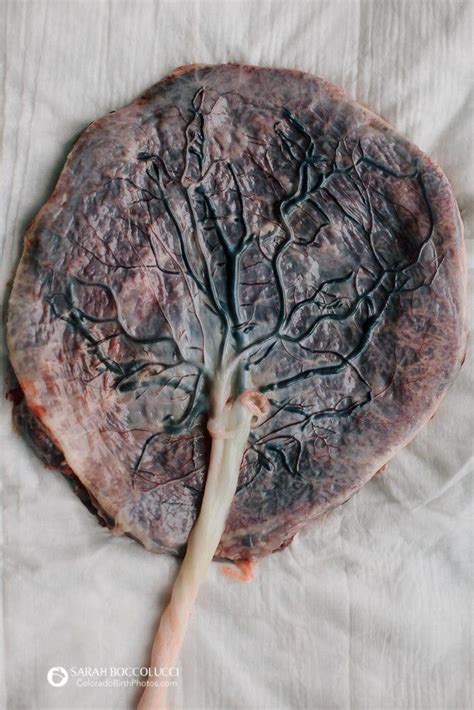 This Image Of A Human Placenta Looks Like The Tree Of Life