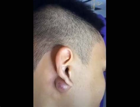 Bump On My Right Ear Archives New Pimple Popping Videos