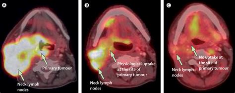 Head And Neck Cancer The Lancet