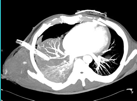 Trauma With Chest Wall Bleed And Pulmonary Hemorrhage Following Chest