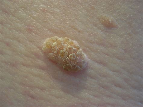 Seborrhoeic Warts Causes Symptoms Treatment Seborrhoeic Warts