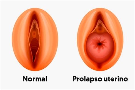 What Is Uterine Prolapse And Treatment Your Health