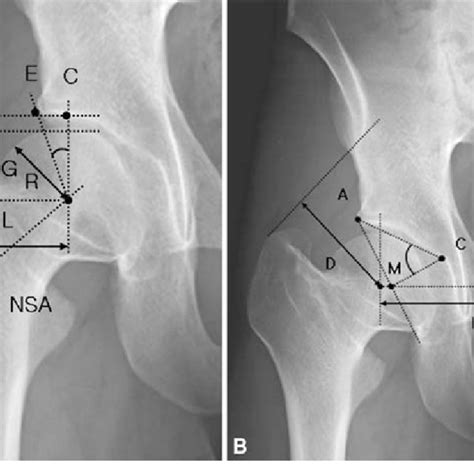 A B A A Standing Anteroposterior Radiograph Of The Hip Of A