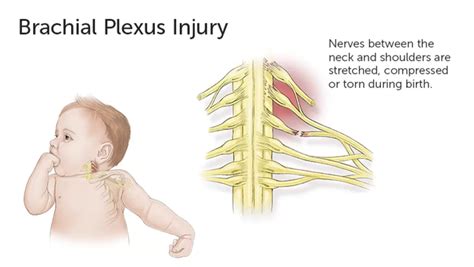 Brachial Plexus Injury Cause Symptoms Treatment Exercise