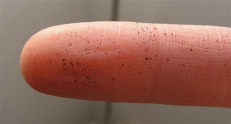 Dark Spots Appearing On Your Hands Suddenly Possible Causes And Best