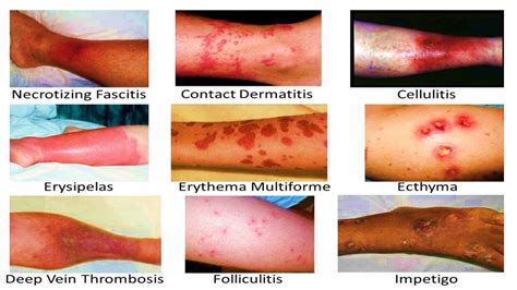 Common Skin Rashes In Dermatology Practice