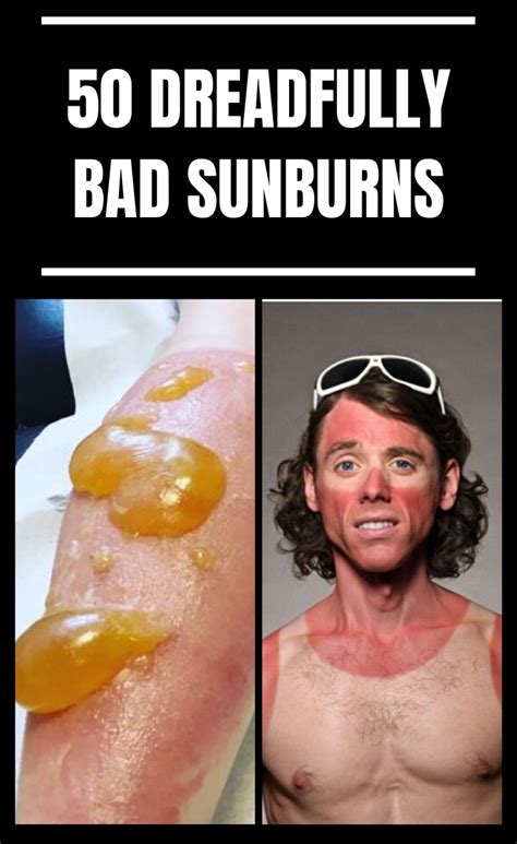 Dreadfully Bad Sunburns Where People Didnt Stand A Chance Against