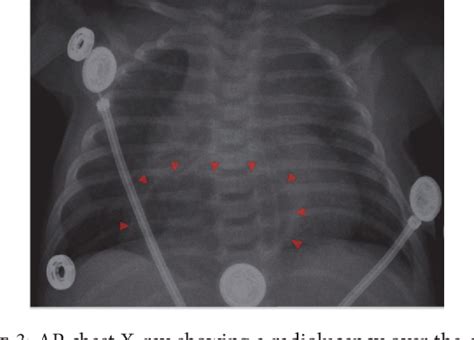 Figure 3 From Severe Hiatal Hernia As A Cause Of Failure To Thrive