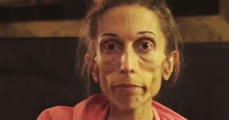 Rachael Farrokh Severely Anorexic Woman Issues Desperate Plea For Help