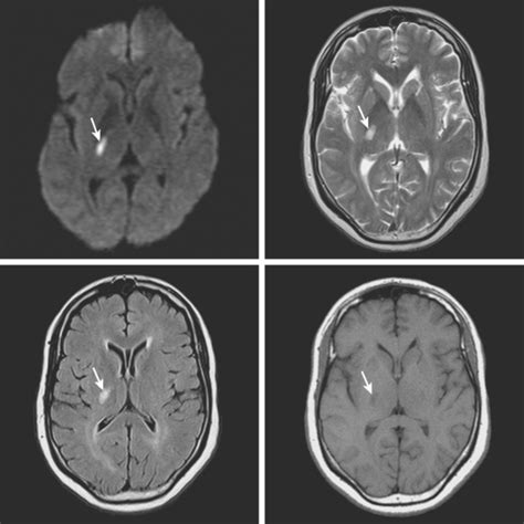 Small Vessel Disease Radiology Key