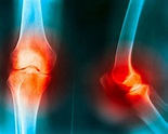 The knee: Anatomy, injuries, treatment, and rehabilitation