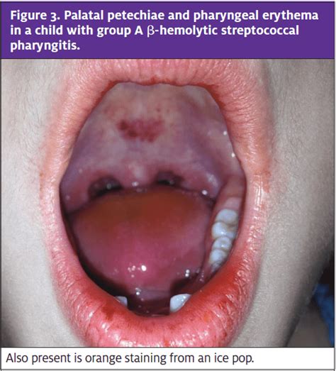 Pediatric Oral Lesions In The Urgent Care Setting Journal Of Urgent