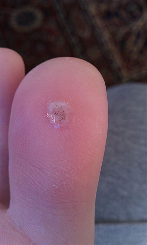 Plantar warts might be one of the more frustrating types of warts, however, since they appear on the feet. How to Treat Plantar Warts