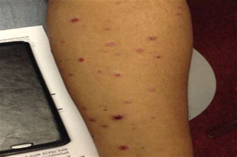 Derm Dx A Pruritic Eruption On The Arms And Trunk Clinical Advisor