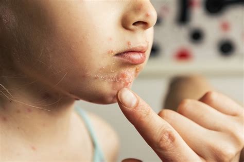 Hand Foot And Mouth Disease In Children Causes Symptoms And Home Care